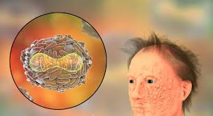 Smallpox was an infectious disease caused by one of two virus variants, variola major and variola minor. äººç±»å¤©èŠ±ç­ç»æ—¥ æˆ'ä»¬ è½¬åŒ–åŒ»å­¦ç½'