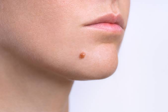 Moles removal in dubai