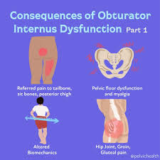 Image result for Obturator Nerve Compression