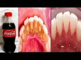 Use Coke This Way Remove Dental Plaque Get A Whiter Teeth In 2 Minutes Youtube White Teeth Dental Dental Plaque