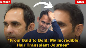 Rediscover Confidence: 1-Year Hair Transplant Journey Testimonial