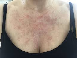 We did not find results for: What Is The Best Treatment For Broken Capillaries On The Chest And Face Photo