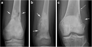 Osteosarcoma is a rare form of bone cancer that usually develops before age 30. The Current Status Of Mri In The Pre Operative Assessment Of Intramedullary Conventional Appendicular Osteosarcoma Springerlink