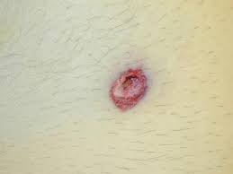 For victims who survive the initial trauma, about 50% die in the emergency room. Forensic Pathology Of Firearm Wounds Overview Modern Small Arms Epidemiology
