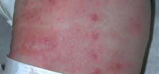 Image result for scabies symptoms