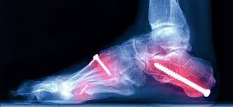 Broken bones in the foot are a common injury. Broken Foot Foot Fracture Causes Symptoms Treatments Recovery