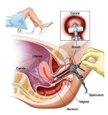 Home laboratorium medik apa itu pap smear? Apa Itu Pap Smear Pap Jamu Manjakani Aura Qaseh Facebook