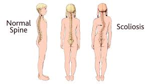 Check spelling or type a new query. One Step At A Time June Is International Scoliosis Awareness Month The Mom Caregiver