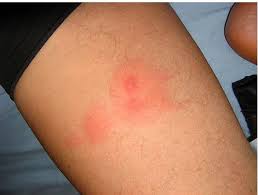 Vous vous demandez certainement comment reconnaitre un bouton de punaise de lit comparé à d'autres insectes piqueurs. Les Punaises De Lit Un Fleau Qu Il Ne Faut Pas Prendre A La Legere Pvtistes Net