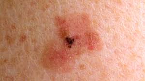 Melanoma, also known as malignant melanoma, is the deadliest type of skin cancer because it can spread quickly (metastasize) to other organs of the body. Melanoma Symptoms Pictures Causes And Treatments