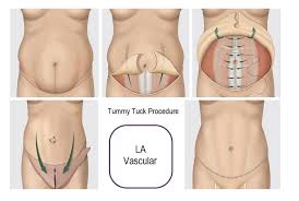 In this case, you play the role of guinea pig for an experimental device or. Tummy Tuck La Vascular