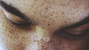These usually develop during the if you decide to try this treatment, make sure you do not apply other medicated topical products, especially benzoyl peroxide, hydrogen peroxide, etc. How To Get Rid Of Freckles 7 Ways