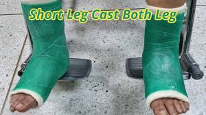 Image result for Short Leg Cast