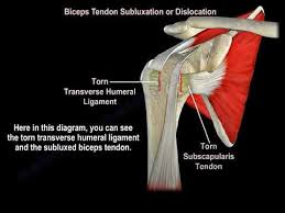 By enclosing the canal of the bicipital groove (intertubercular groove), it functions to hold the long head of the biceps tendon within the bicipital groove. Biceps Tendon Subluxation Or Dislocation Everything You Need To Know Dr Nabil Ebraheim Youtube