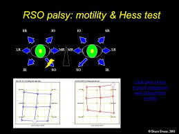 Rso Palsy Motility Hess Test Ppt Video Online Download