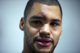 Leafs defenceman Mark Fraser thankful his head injury wasn't more serious