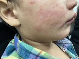 Image result for measles