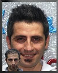 Protez Sac Sac Sac Urunleri Sac Dokulmesi