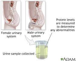 Proteinuria is increased levels of protein in the urine. Protein Urine Test Medlineplus Medical Encyclopedia Image