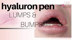 Sparta beautiful hyaluronic serum acid, 2.5 ml is ha, for the hyaluron pen (pen not included product is needle free) no needles i absolutely love your filler quality. Filler Lumps And Bumps Hyaluron Pen Youtube
