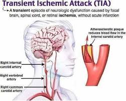 Tia Transient Ischemic Attack In 2020 Transient Ischemic Attack Medical Mnemonics Medical