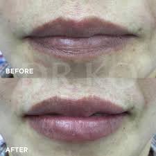 Quality dermatologist, skin specialist and skin clinics in old klang road, rated 4.9 over 5 from 96 verified reviews by our community medical so we always work to find and compile information on skin (dermatology) clinics services in old klang road through surveys, treatment experience. Ko Skin Specialist Klang Skin Specialist In Klang