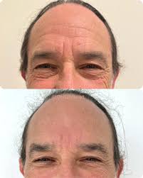 Forehead Filler