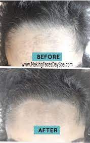 Microblading Hairline Restoration Depti Http Www Makingfacesdayspa Com Eyebrow Html Microblading Hairline Eyebrows
