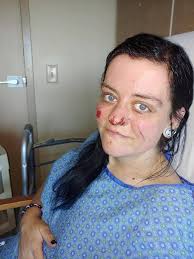 Surviving a severe car accident with injuries