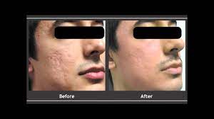 The first step to planning co2 laser treatment is to book a consultation with dr. Co2 Laser For Scars Before After Youtube