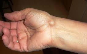 Linkes handgelenk sehr stark am schrank gestoßen. Ganglion Ursachen Symptome Behandlung Onmeda De