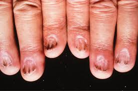 disorders of the nails and nail