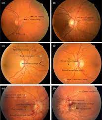 Hypertensive Retinopathy Eye Facts Medical Knowledge Eye Anatomy