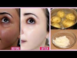 Black And White Bleaching Cream Before And After Pin On Baking Soda Facial Remedy