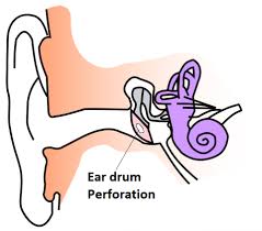 The british tinnitus association is a registered charity. Best Ear Drops To Clean Your Ears Of Wax Correctly Your Hearing Helper