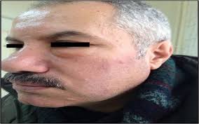 Morbihan disease (md) is a rare condition but can be a very rewarding diagnosis to make. December 2016 Clinical Dermatology Research Journal