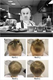 Jonny Belgravia Centre Hair Loss Blog Find out about the clinics and why our medical facilities and hair loss products set us aside from the rest, and meet our team of more than belgravia's director, jonny harris, talks about a number of different topics related to hair loss. jonny belgravia centre hair loss blog