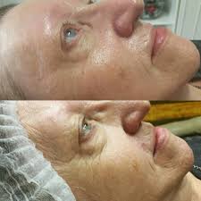 التقشير الاستشفائي بالأعشاب green peel the power of natural beauty