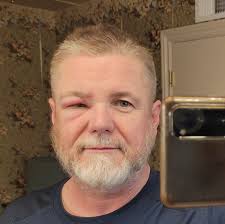 How to treat a bee sting with severe swelling?