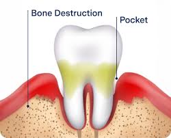 Image result for Periodontal Abscess