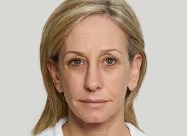 Sculptra in Denver, Boulder & Fort Collins