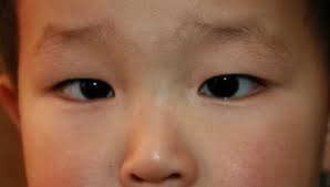 Their faces are flat, and they have legs and. Strabismus Disorders Ento Key