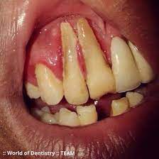Gingival Recession Receding Gums Refers To The Progressive Loss Of Gum Tissue Which Can Eventually Result In Tooth Root E Dental Fun Dental Health Dentistry