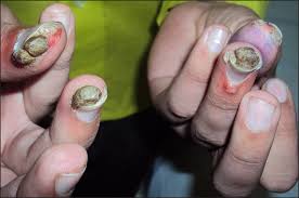 is nail polish good for warts