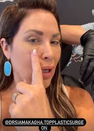 RHOC's Emily Simpson looks unrecognizable as she debuts her fresh new face  after eyelift surgery