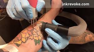 According to the american society for aesthetic plastic surgery, the national average cost of laser removal is. Red Ink Tattoo Removal By Ink Revoke Youtube