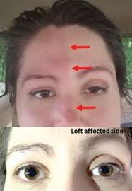 The exquisite posture of dancers — neck long, back erect and shoulders down — creates the appearance of. Horner S Syndrome May Be Unexpected Complication After Thyroid Surgery