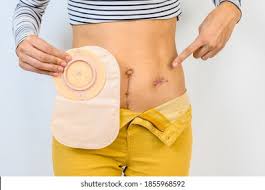 Scars Crohns Hd Stock Images Shutterstock