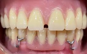 Image result for dentures