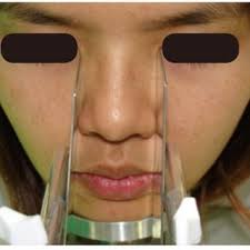 PDF) The relationship of maxillary canines to the facial anatomical  landmarks in a group of Thai people